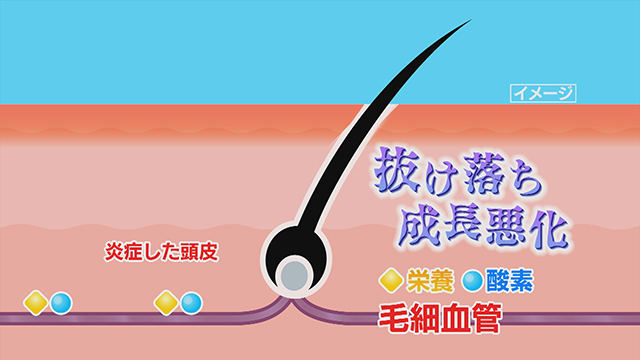 引用：あさイチ「髪や頭皮のＳＯＳをキャッチするには？」