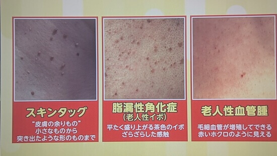 【引用:あさイチ】首のポツポツ画像